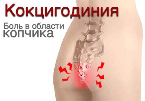 Правка копчика, кокцигодиния, коррекция копчика